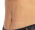 retinoid cream for stretch marks