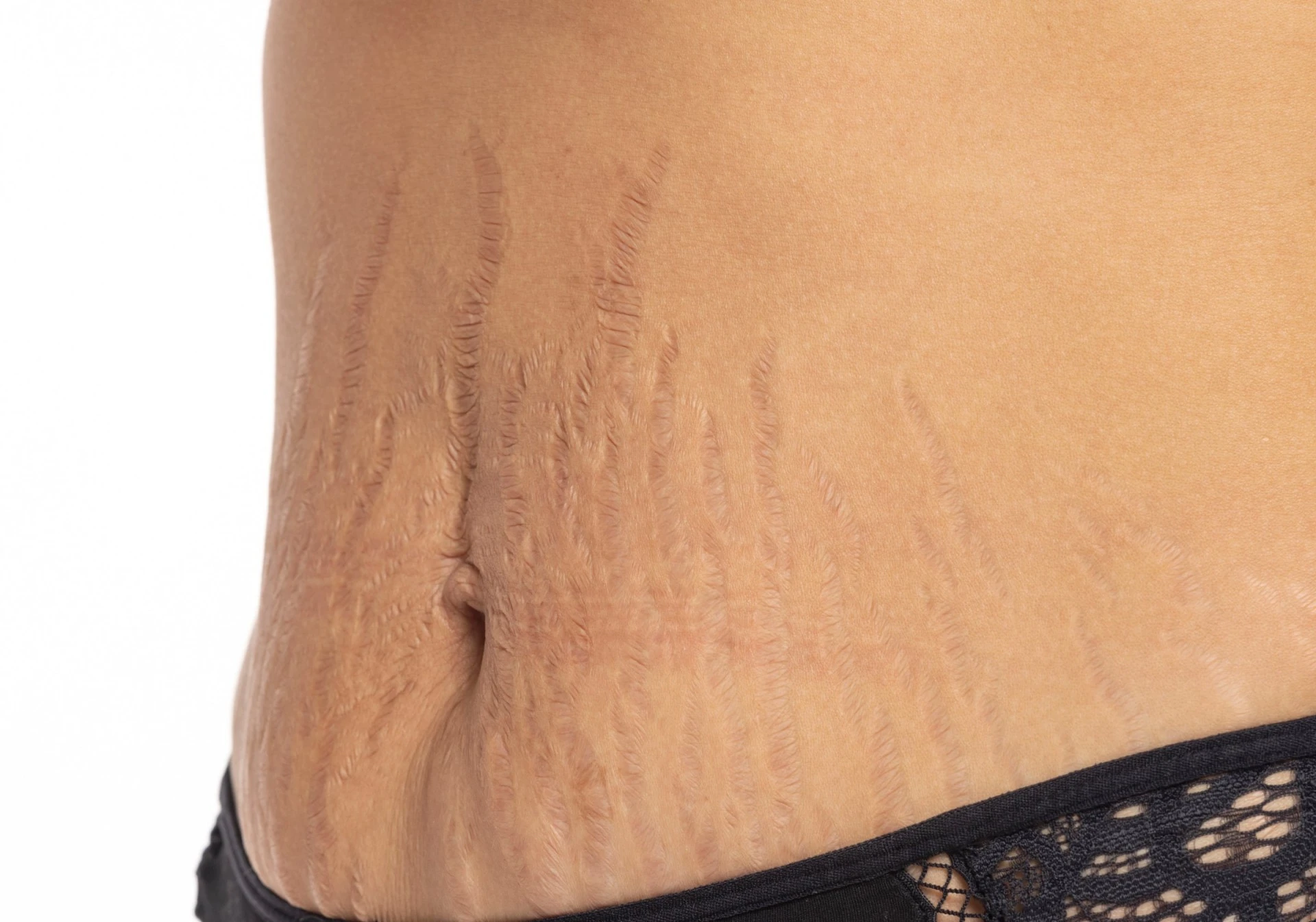 retinoid cream for stretch marks