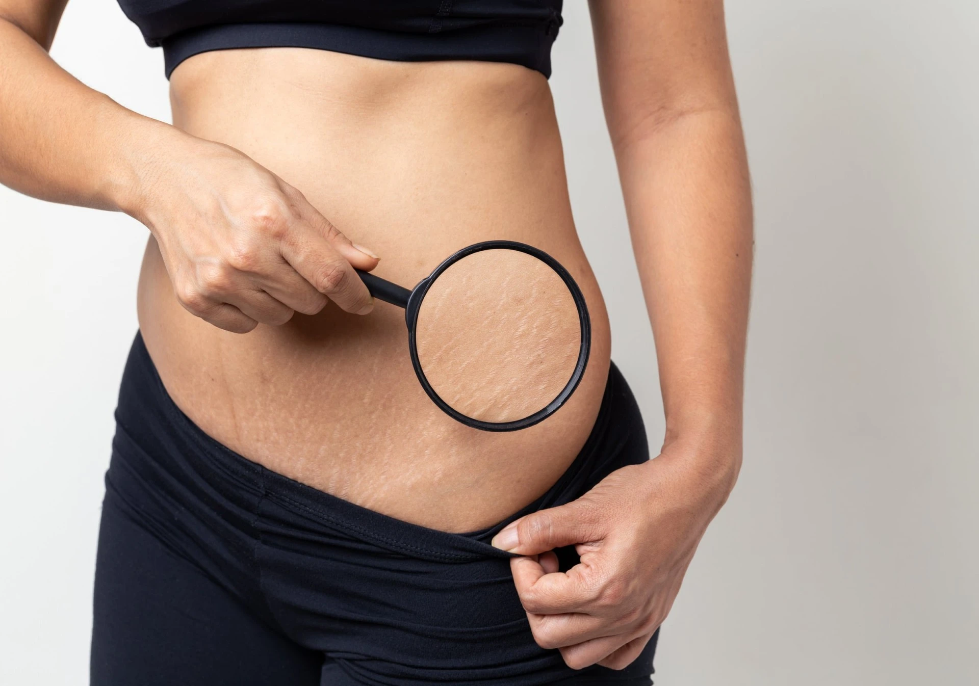 tretinoin cream for stretch marks